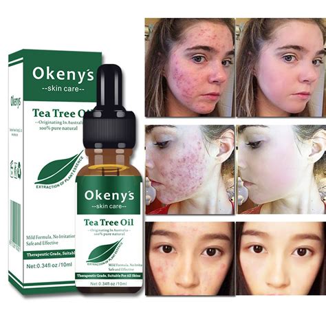Tea Tree Essential Oil Anti Wrinkle Acne Removal Scars Treatment 10ml