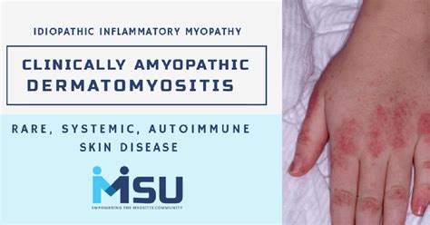 Clinically Amyopathic Dermatomyositis Cadm Myositis Support And