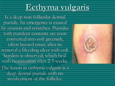 Ecthyma As Related To Dermatitis Pictures