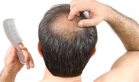 Hair Loss Cure Experts Reveals What Can Stop Balding Health Life