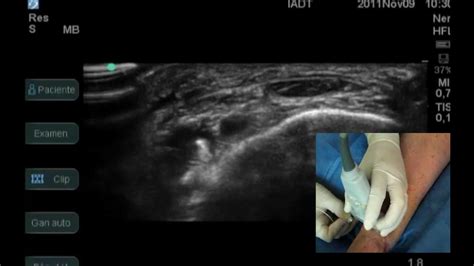 Ultrasound Guided Anterior And Posterior Tibial Nerve Blockmov Youtube