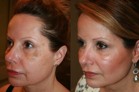 Patient Story 50 Year Old Female Patient Ultherapy Thread John
