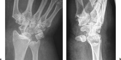 Carpal Fractures And Dislocations Radiology Key