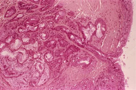 Chronic Bronchitis Light Micrograph Stock Image M1200115