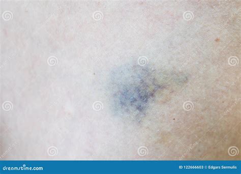 Close Up On A Fresh Bruise On The Skin Stock Image Image Of Legs