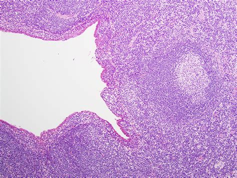 Lymphoepithelial Cysts