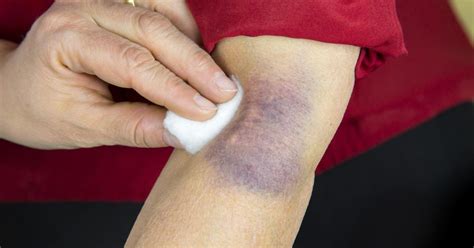Bruise Types Symptoms Causes Prevention Treatment