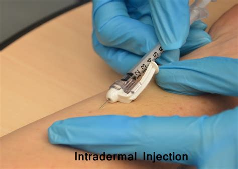 Intradermal Injection Procedure