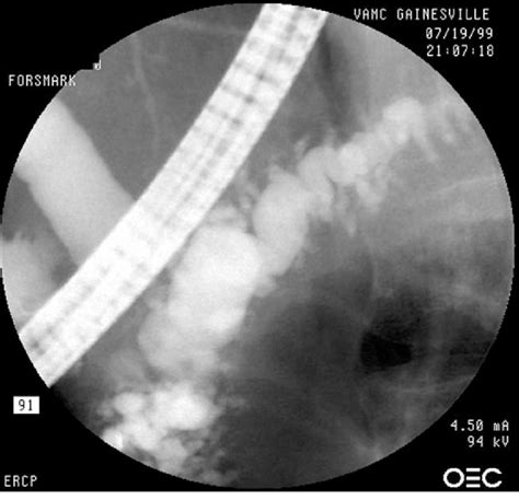 An Endoscopic Retrograde Cholangiopancreatography Ercp Demonstrating