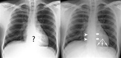 Chest X Ray Quality Penetration