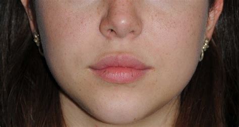 Lip Augmentations With Fat Injections Healing Image Diary