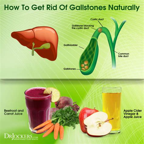 Awesome Info About How To Avoid Getting Gallstones Commandbid31