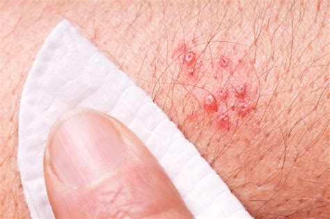 Truth About Shingles Healthy Headlines