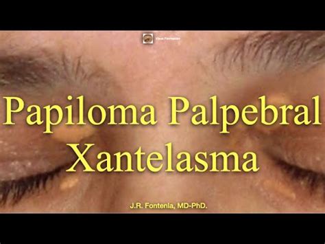Papiloma Palpebral Xantelasma Youtube