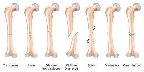 Oblique Bone Fracture Intseka