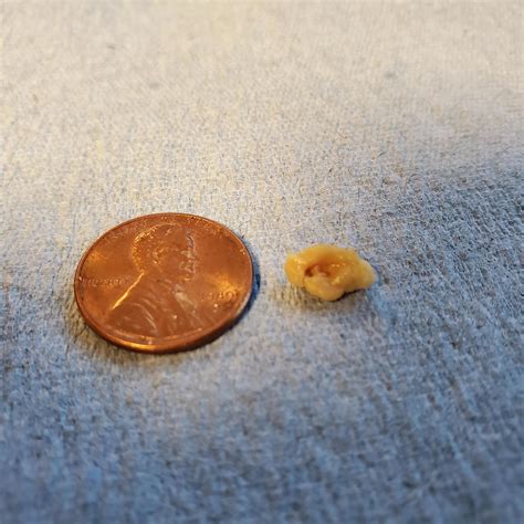 Biggest Tonsil Stone For My 46 Years Penny For Scale Popping