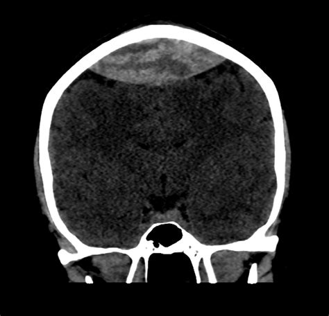Bilateral Craniotomy For Superior Sagittal Sinus Related Epidural