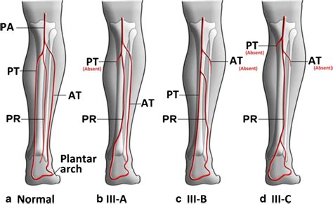 Normal A And Type Iii Popliteal Artery Branching Patterns Ac Bd