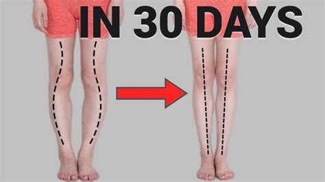 Get Straight And Longer Legs In Days Fix Knee Internal Rotation