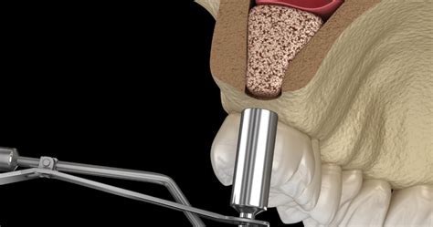 Sinus Lift Dental Implants Surgical Dental Extraction