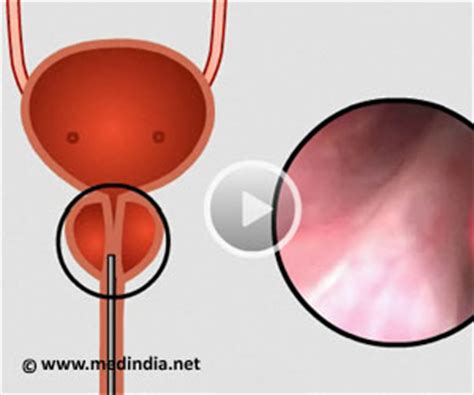 Transurethral Resection Of Prostate Turp Health Video Medindia