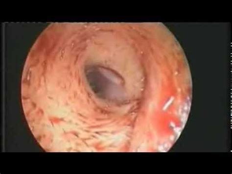 So dirty on the inside? Doctors Find Fruit Fly Larvae Inside Woman's Ear - YouTube