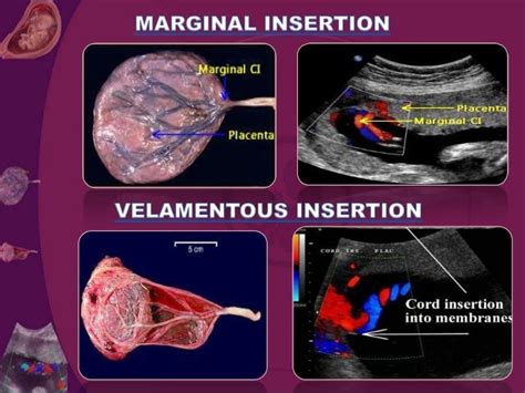 Umblical Cord Presentation