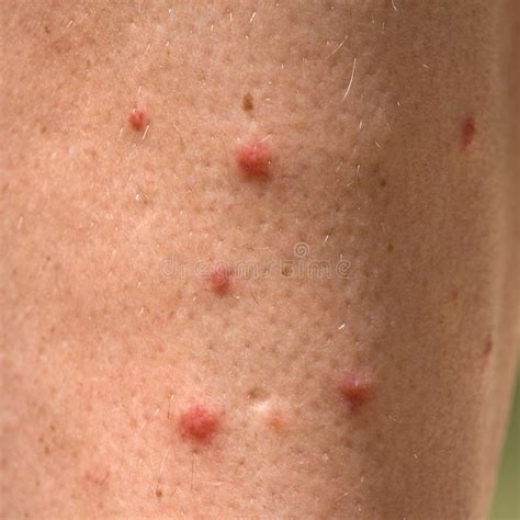 Allergic Rash Dermatitis Leg Skin Stock Photo Image Of Caucasian