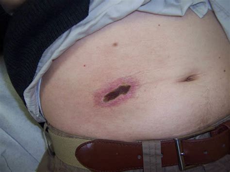 There are many causes of necrosis including injury, infection, cancer, infarction, toxins and inflammation. Necrosis cutánea por interferón - Ocronos - Revista Médica ...