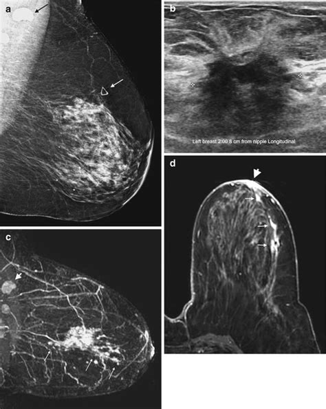 Mri And Preoperative Staging In Women Newly Diagnosed With Breast