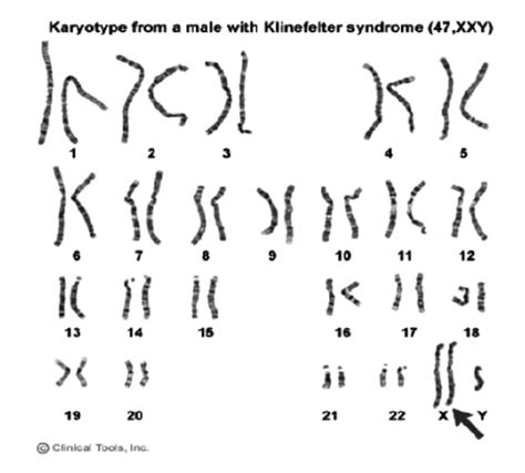 A Karyotype Of Klinefelter Syndrome Explained Karyotypinghub Images And Photos Finder
