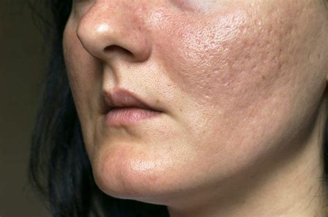Acne Scar Treatments And Removal Dr Haus Dermatology