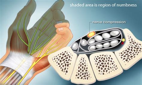 Carpal Tunnel Syndrome Spine Specialist