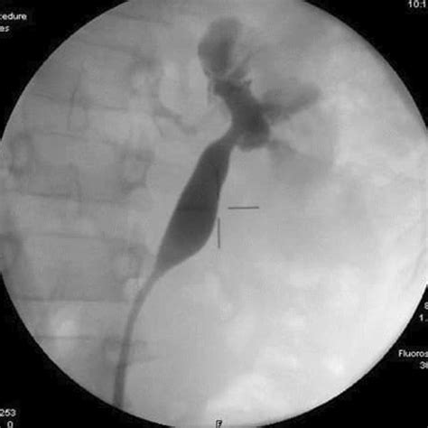 Dye Injection In The Left Ureter Showing The Pelvis And The Ureter