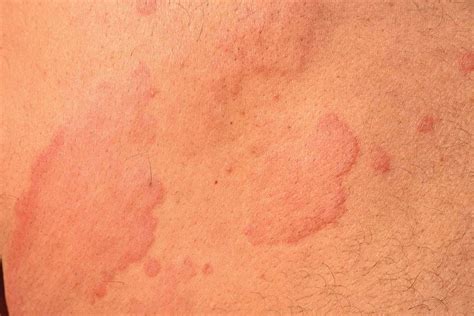 Hives Vs Rash Symptoms Causes Treatment