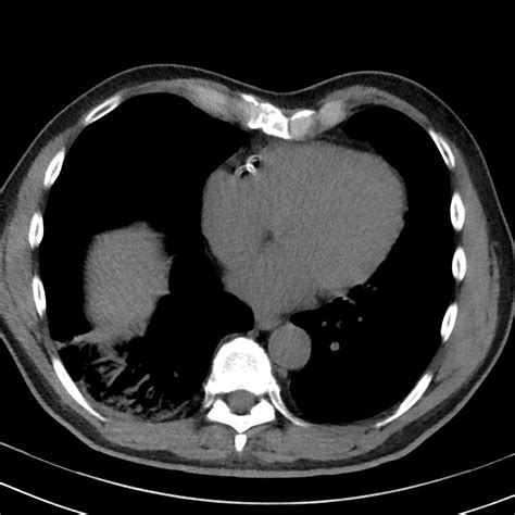 Acute Pulmonary Embolism Image Radiopaedia Org