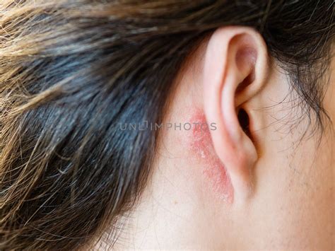 Irritation On The Skin Behind The Ear Man With Flaky Skin Alle