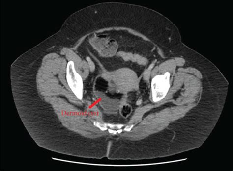 Transverse View Of Ct Abdo Pelvis Showing A Dermoid Cyst In The Right