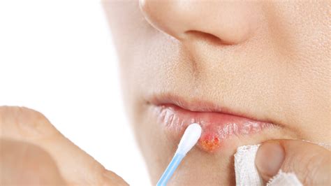 Cold Sore Remedies How To Treat And Prevent Cold Sores On Your Lips