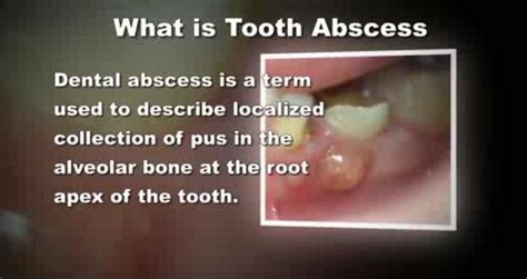 Cure Tooth Abscess Naturally In Record Time With This Powerful