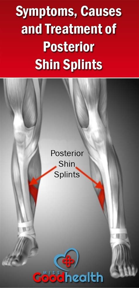 Pin On Shin Splint