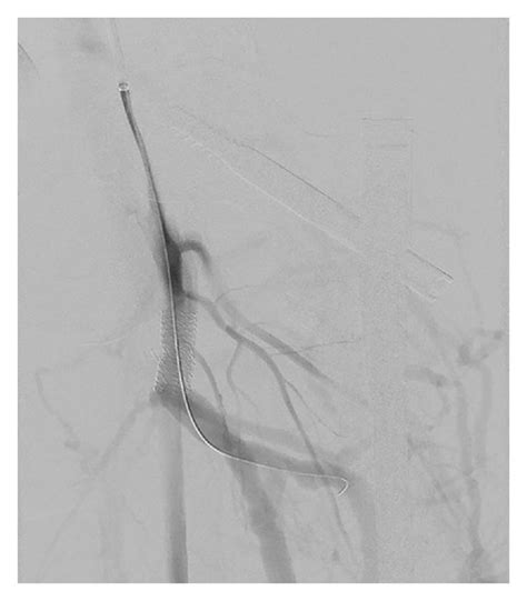 Angiogram Of Left Lower Extremity Showing A The Left Profunda Femoris