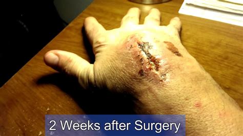 Ganglion cysts on the feet often require surgery for removal, simply due to how much pressure the feet have to deal with every day. Warning Graphic! Huge Ganglion Cyst Popping and Removal ...