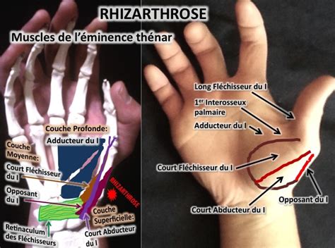 Douleur Base Du Pouce Face Interne Au Pouce Et Si L Arthrose Wonlex Fr