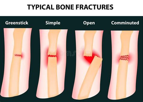 Typical Bone Fractures Vector Scheme Sponsored Bone Typical