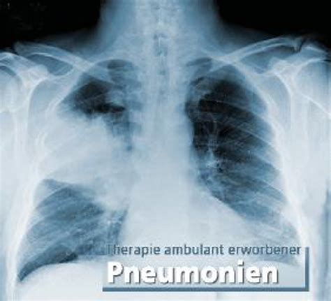 Behandlungskonzepte Ambulant Erworbener Pneumonien