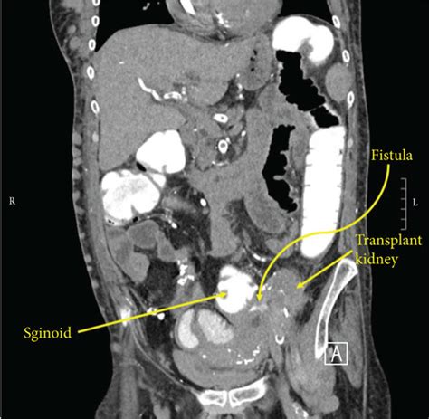Sagittal Ct Of The Abdomen And Pelvis With Rectal Contrast