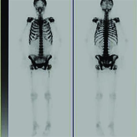Figure2bone Scintigraphy Demonstrated The Increased Uptake Of
