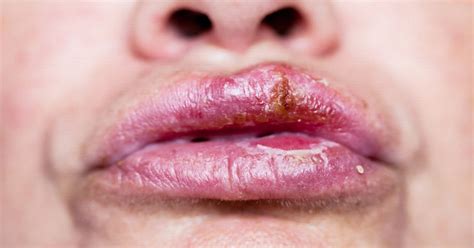 Is It Really Herpes 10 Common Cold Sore Myths Debunked Daily Star