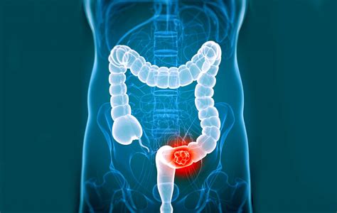Signs And Symptoms Of Colorectal Cancer